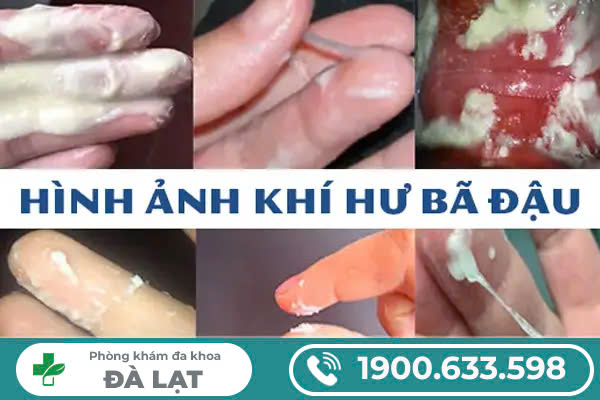 Ra khí hư trắng như bã đậu: Nguyên nhân và cách điều trị
